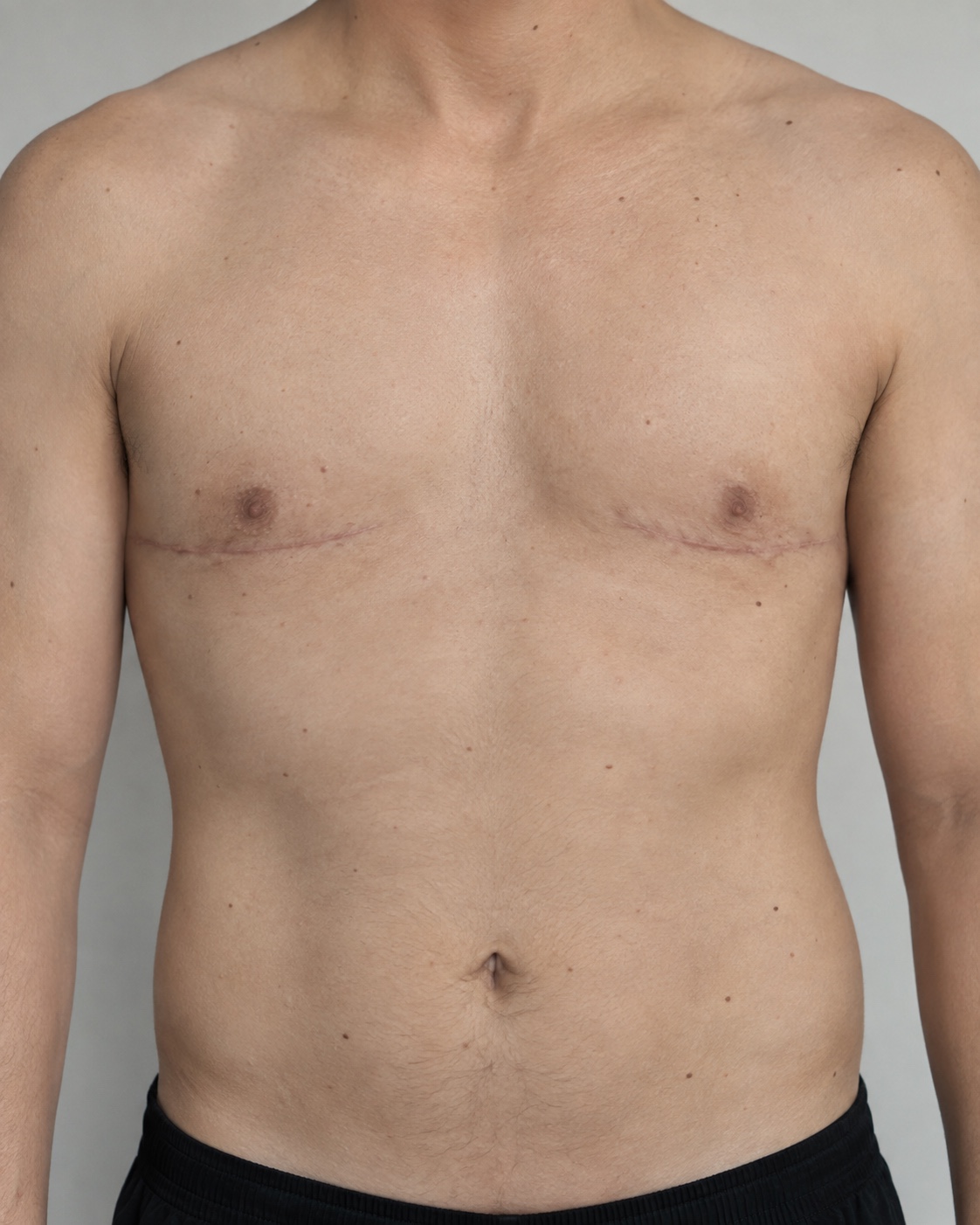 Imagem ilustrativa de possível contorno torácico após cirurgia masculinizadora