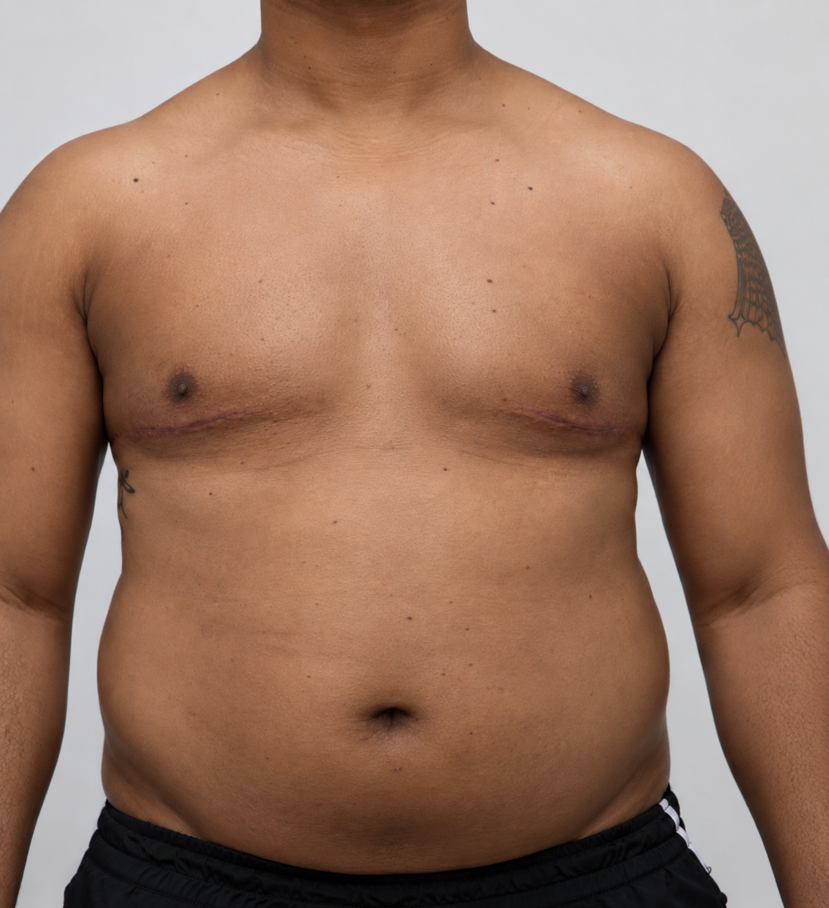 Imagem ilustrativa de contorno torácico em corpo com maior volume