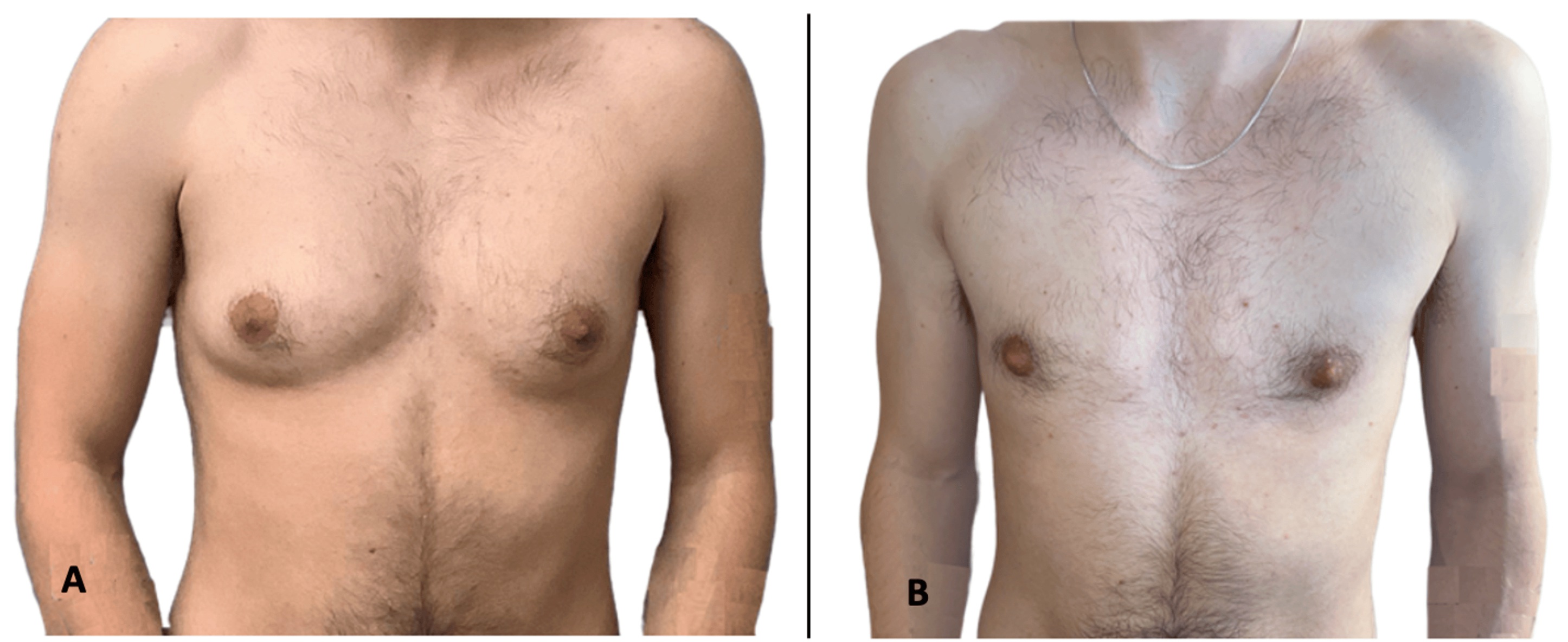 Comparação clínica do tórax antes e três meses após cirurgia pela técnica Keyhole