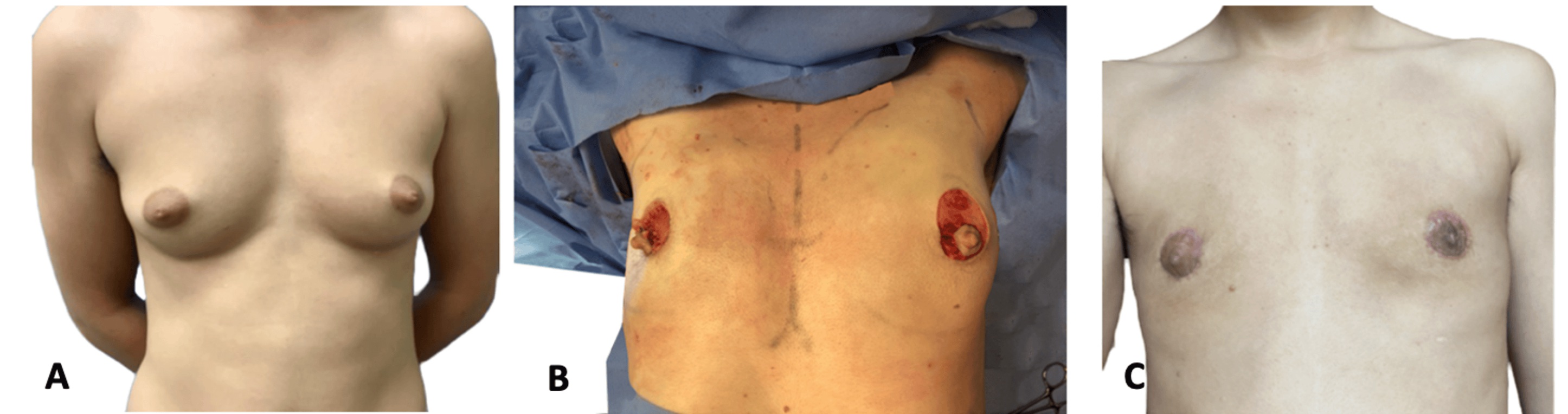 Sequência clínica da técnica periareolar antes da cirurgia, durante o procedimento e treze meses depois
